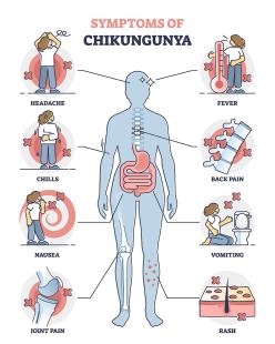 chikungunya symptoms