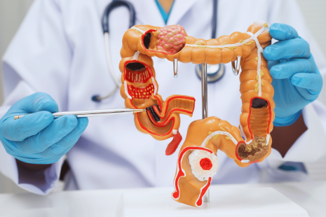 schéma intestin, cancer colorectal