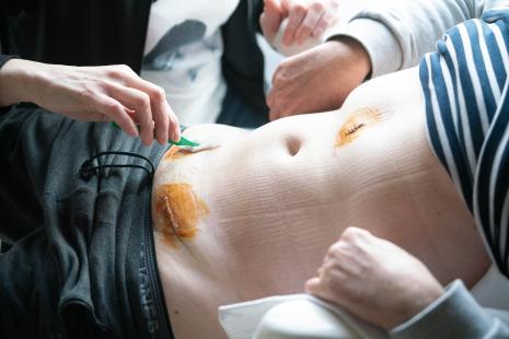 Infirmière libérale désinfectant la cicatrice d'un patient. 