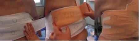 compression locale bandage thoracique