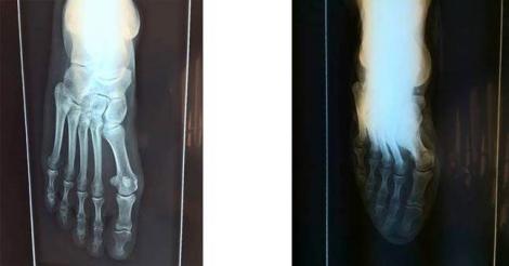 Hallux