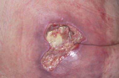 la physiopathologie des escarres