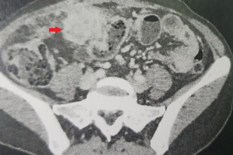 actinomycoses pelviennes