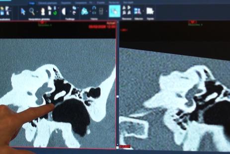 Surdité : le scanner met le pied à l'étrier