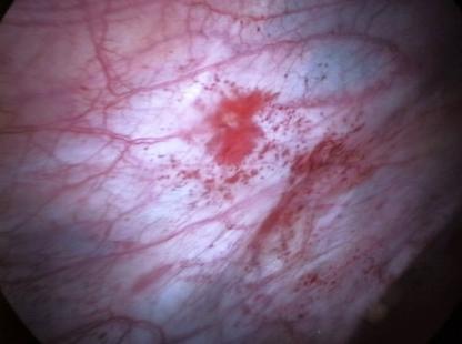 Un retard de diagnostic de 7 ans en moyenne