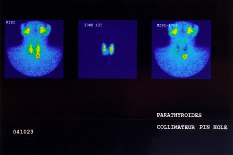 Maladie rare, l'hypoparathyroïdie chronique concerne entre 10 000 et 16 000 patients en France