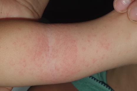 formations vésiculeuses au niveau du pli du coude