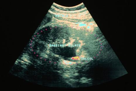 En cas de calcul rénal, le degré d’urgence dépend des signes associés