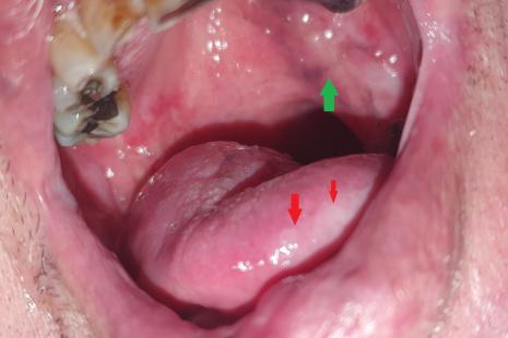 Carcinome épidermoïde du palais (flèche verte) et leucoplasie de la langue (flèches rouges)
