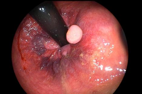 Endoscopie montrant des hémorroïdes internes (violet) et un fibrome anal. 