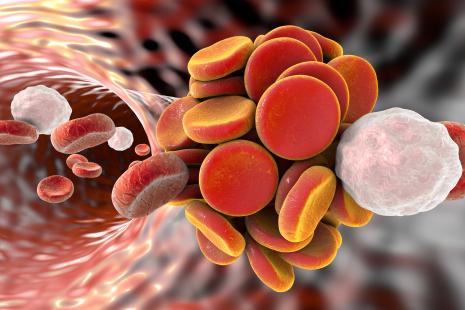 Image de synthèse montrant un caillot sanguin contenant des globules rouges et des leucocytes (en blanc). 