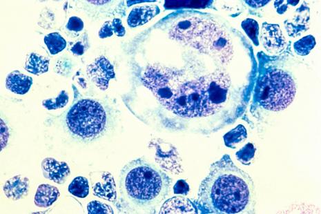 lymphome