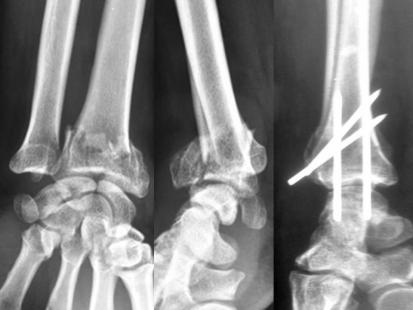 Fracture du poignet