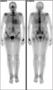 amyloses cardiaques