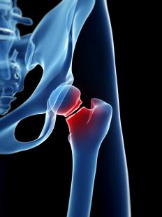fracture hanche
