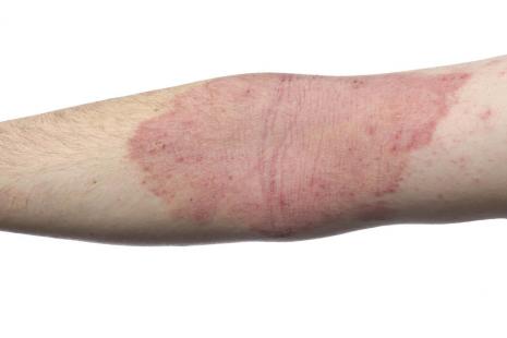 eczema