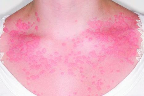 Toute réaction n’est pas allergie