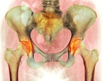arthrose