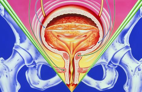 incontinence
