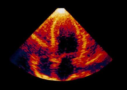 hypertrophie ventriculaire gauche