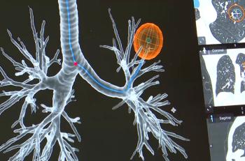 L'ablation pulmonaire en bonne voie