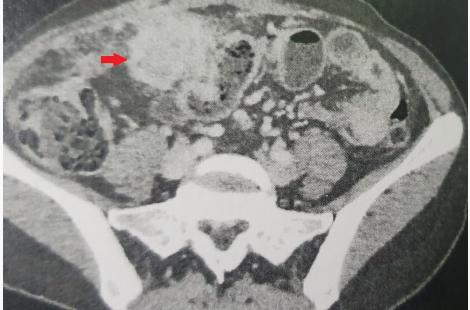 Les actinomycoses pelviennes