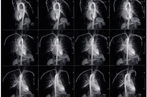 L’IRM cardiaque performante pour le diagnostic des infarctus du myocarde sans sténose Minoca 
