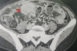 Les actinomycoses pelviennes