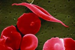 Drépanocytose : le PLGF est prédictif de la prééclampsie précoce