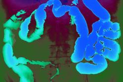 Maladie de Crohn : découverte d’un virome sanguin spécifique