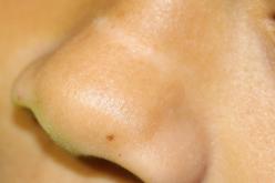 La ligne nasale transverse