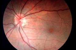 AVC de l’œil : la ténectéplase pas plus efficace que l’aspirine mais plus risquée