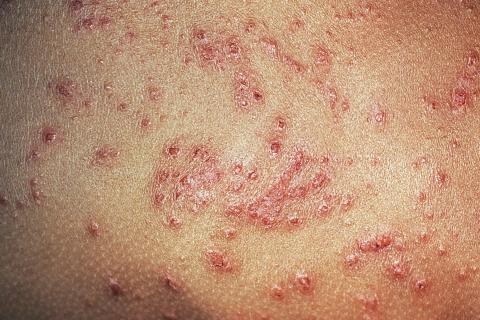 EADV 2025 : la dermato par-delà la surface