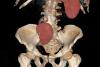 Maladie rénale chronique : l’empagliflozine est bénéfique même en cas de pathologie à faible risque évolutif