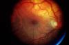 DMLA ­atrophique : un implant sous-rétinien restaure partiellement la vision