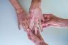 Vitiligo, les débuts d’une révolution