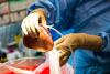 Métastases hépatiques des cancers colorectaux : cap sur l’immunothérapie et la greffe