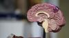 Alzheimer : que révèle l’autopsie d’un patient traité pendant plus de quatre ans par aducanumab ?
