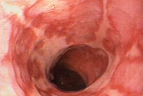 oesophage