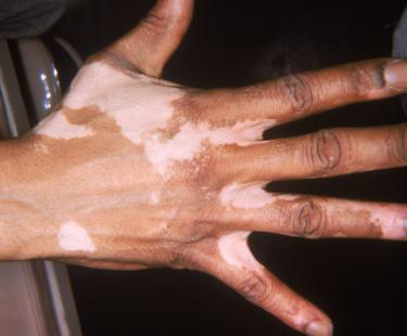 vitiligo