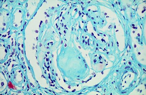 Lésions d'un glomérule rénal d'un diabétique entraînant à terme une insuffisance rénale