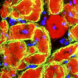 Muscle atteint de myopathie de Duchenne. Microscopie optique.