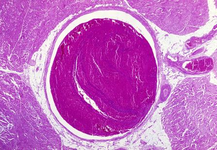 Un mécanisme immunologique à l’origine des rares cas de thromboses