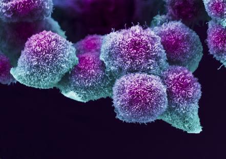 Le cancer du pancréas, peu fréquent, est de mauvais pronostic