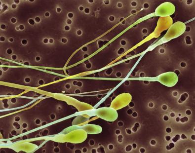 Le risque malformatif n'est augmenté que si le père prenait de la metformine durant la période de développement des spermatozoïdes