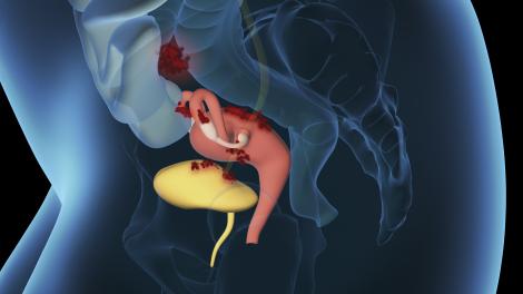 La maladie est définie par la présence ectopique du tissu endométrial