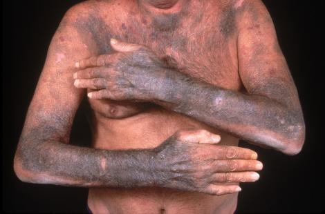 Patient atteint d'une photosensibilisation médicamenteuse (antibiotique).