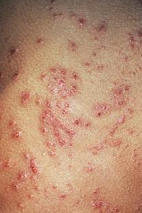 Cinq nouveaux médicaments sont indiqués dans le traitement de la dermatite atopique.