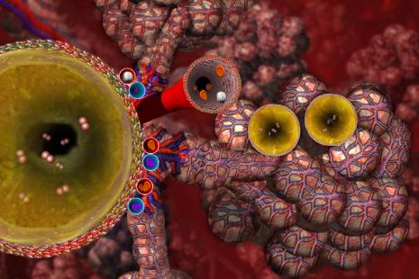 Poumon atteint de mucoviscidose. Les bronchioles et les alvéoles pulmonaires sont obstruées par du mucus (jaune). Image de synthèse.