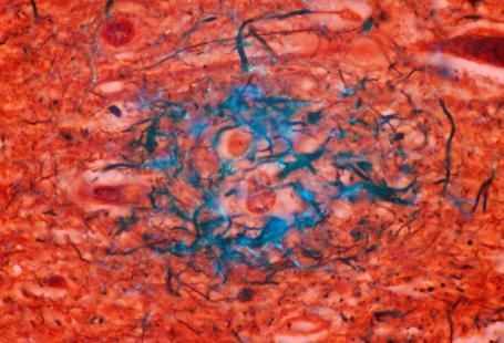 Plaques séniles dans la matière grise d'un cerveau atteint de la maladie d'Alzheimer. Microscopie optique, grossissement x1000.